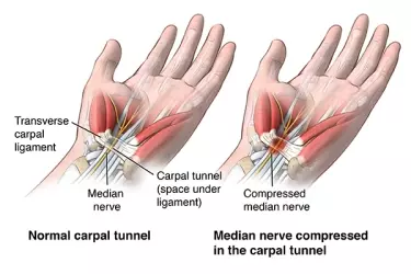 carpal tunnel syndrome